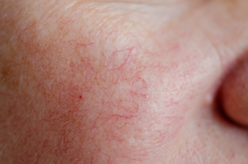 Spider Veins on Face | Info & Treatment