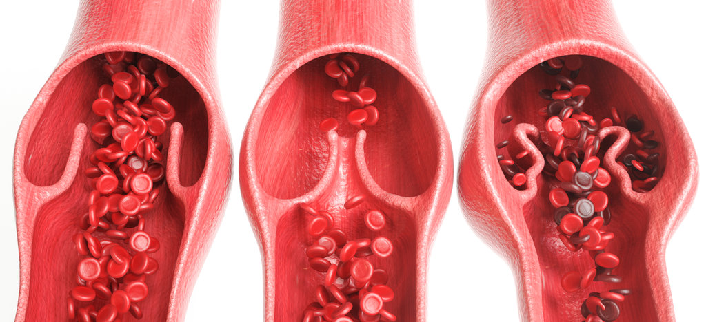 Varicose vein compared to healthy veins