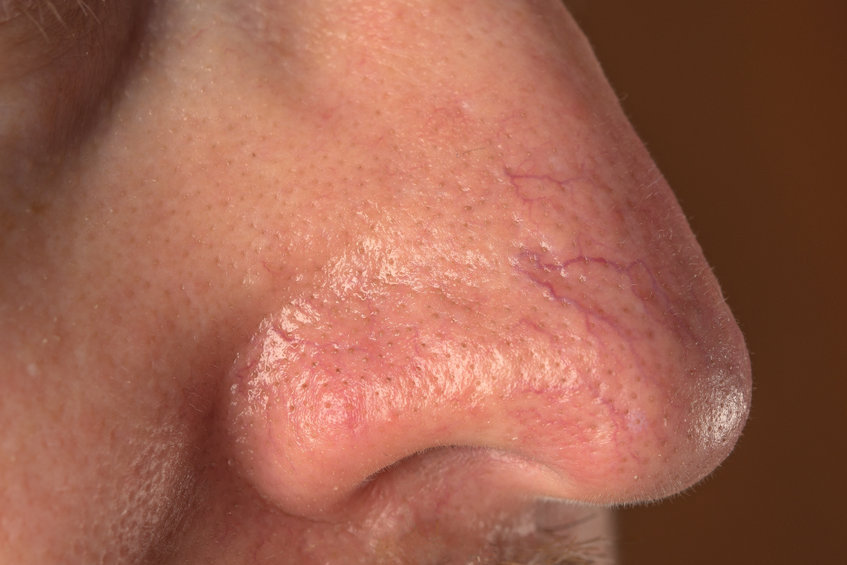 spider veins on face and nose - top vein clinic nyc