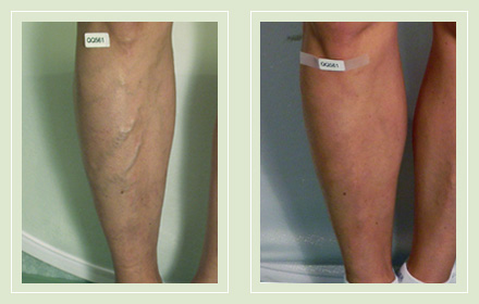 Endovenous Laser Ablation – The Vein Treatment Center