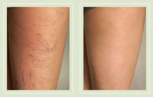 Legs – The Vein Treatment Center