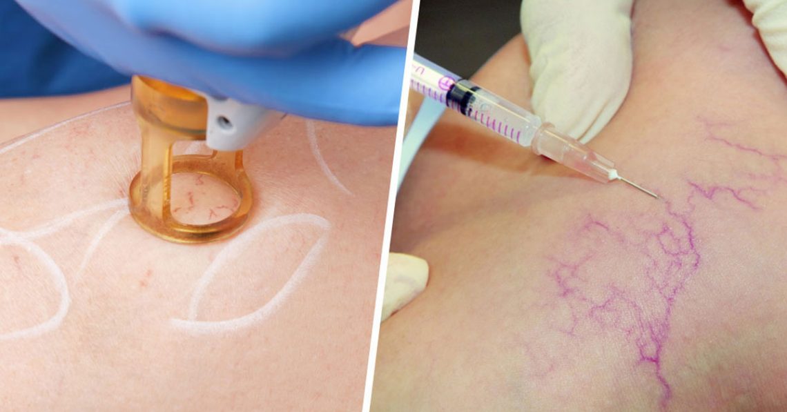 Sclerotherapy and laser treatment for spider veins