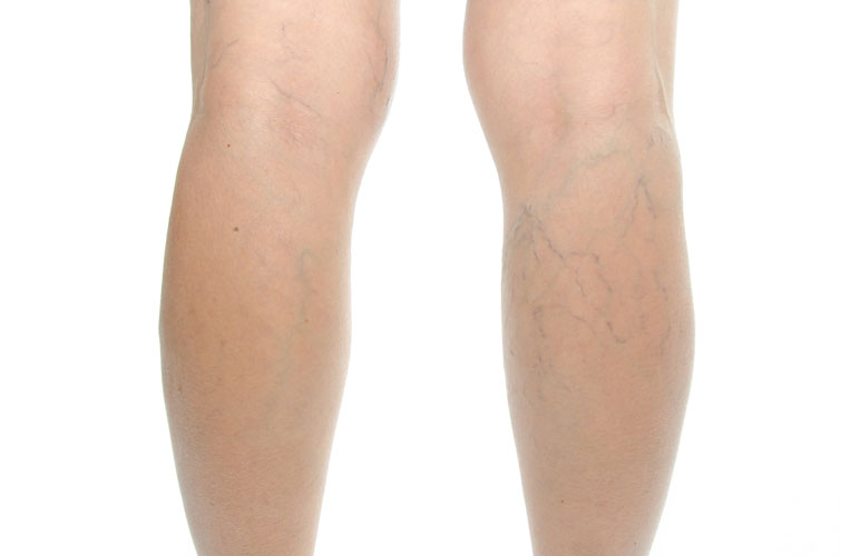 Varicose veins on legs treatment